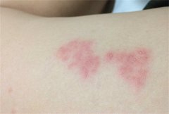 疱疹感染的危害