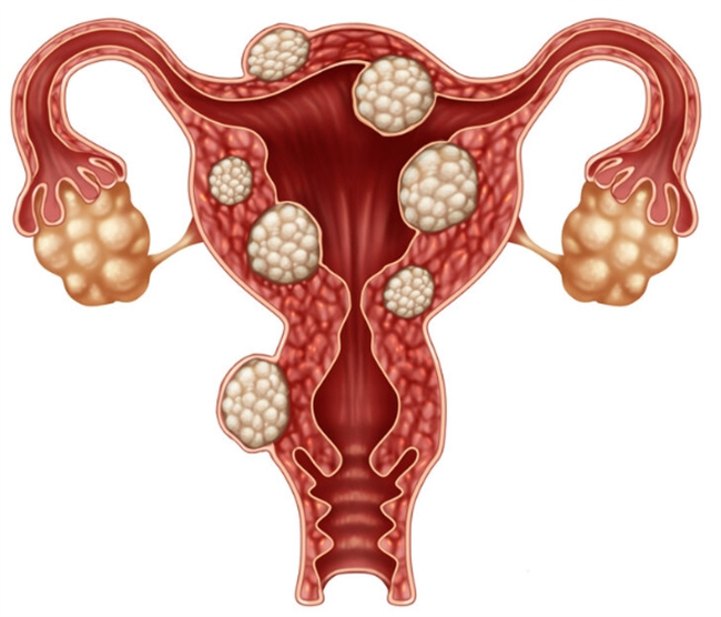 女性健康生活，从了解子宫肌瘤开始