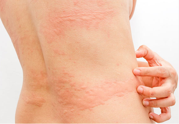 风疹传染途径与易感人群解析