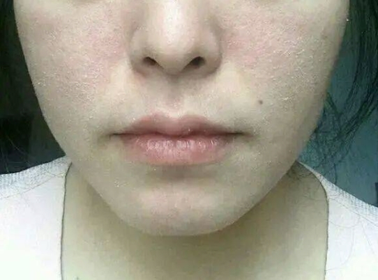 秋季护肤指南：告别脸部脱皮的困扰