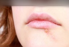 解析疱疹：最有效治疗方法及病因深度剖析