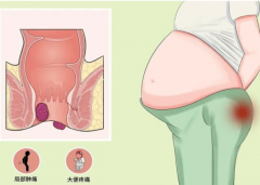 孕期痔疮护理指南：预防与缓解方法解析