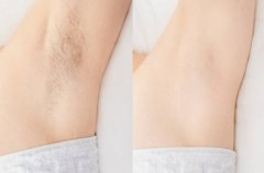 揭秘激光脱毛腋下：究竟有多疼？