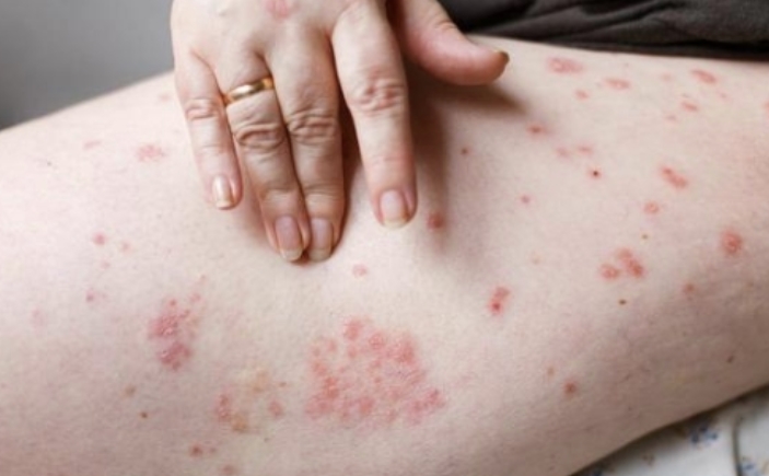 丘疹性荨麻疹与湿疹：了解疾病背后的不同之处