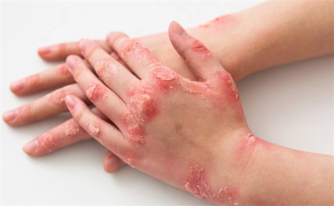 解密疥疮最佳治疗方法，专家揭示科学应对之道