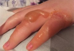 初生牛犊不怕虎：孩子烫伤应急五步曲