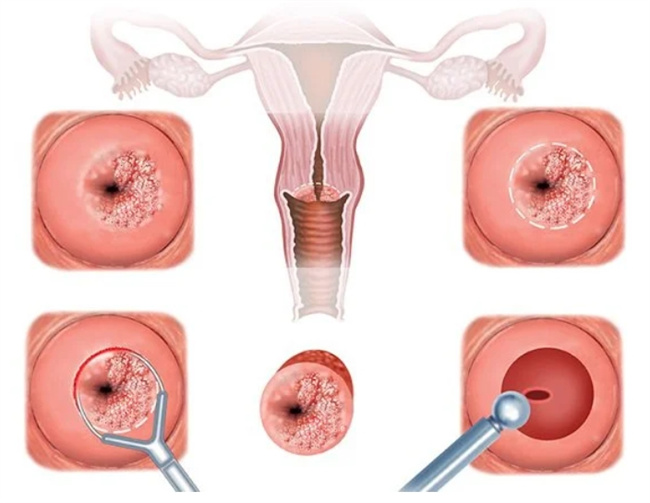 解读宫颈LEEP手术：痛苦真的可避免吗？