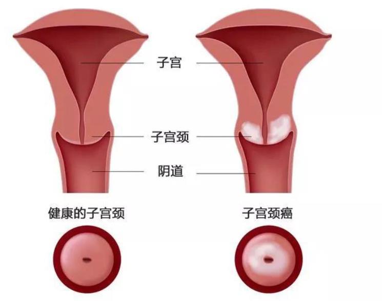 揭秘宫颈糜烂：症状与不同程度的警示