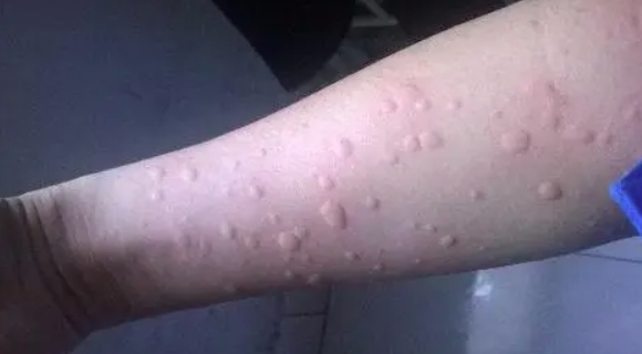 中药调理,缓解荨麻疹困扰