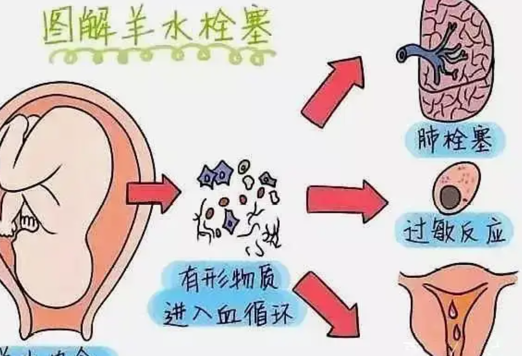 羊水栓塞植物人？羊水栓塞预防？别急，听听医师怎么说！