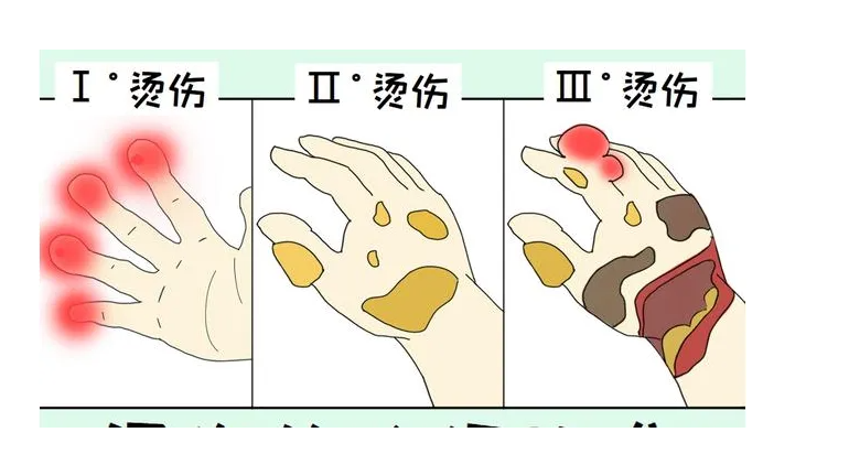 打翻热水溅到3个月大儿子的脸，妈妈没送医自行擦药，7天后不治！正确判断烧烫伤，不因误判造成憾事！