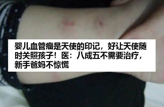 婴儿血管瘤是天使的印记，好让天使随时关照孩子！医：八成五不需要治疗，新手爸妈不惊慌