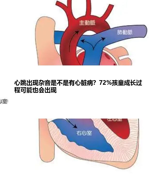 心跳出现杂音是不是有心脏病？72%孩童成长过程可能也会出现