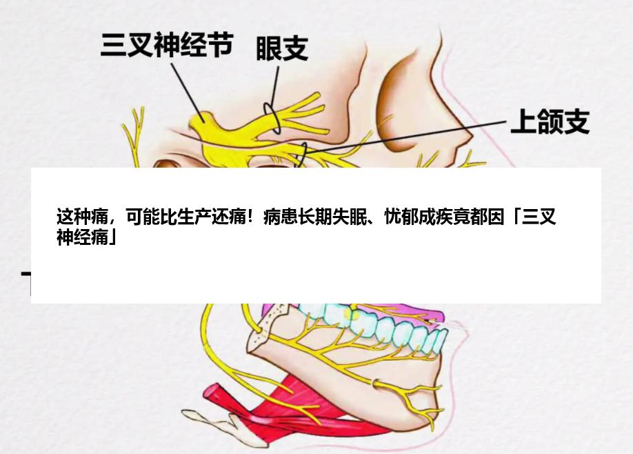 这种痛，可能比生产还痛！病患长期失眠、忧郁成疾竟都因「三叉神经痛」