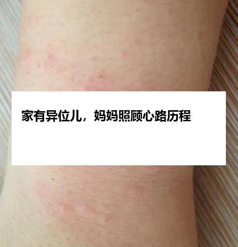 家有异位儿，妈妈照顾心路历程