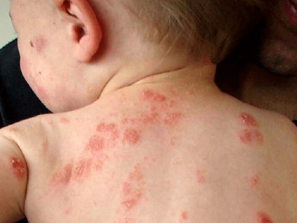 从A-Z关于婴儿脓皮病的知识