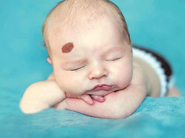 我以为我有一个幸运的痣,谁怀疑是血管瘤!