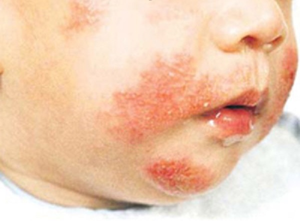 婴儿皮炎: 如果母亲不及早治愈,婴儿容易出现并发症