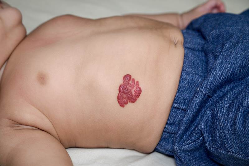 出现婴儿血管瘤，家长好著急！医：大多数无须治疗