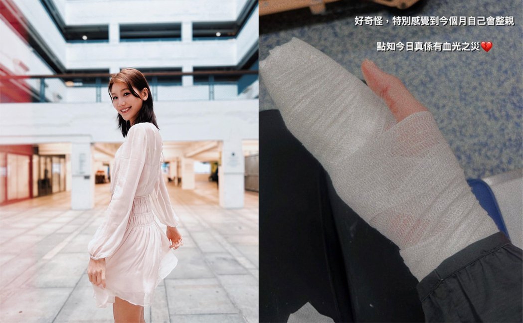 女优遭无牵绳洛威拿犬咬伤当场喷血手缠绷带住院中