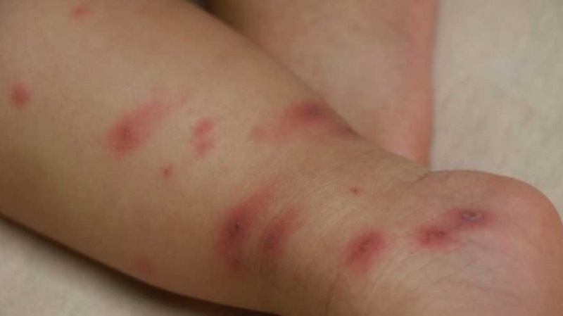 未满1岁女婴全身狂冒水痘、高烧不退母也中奖，罪魁祸首竟是爸爸长皮蛇