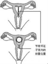 上环真的有那么恐怖吗?最好的取环方式又有哪些