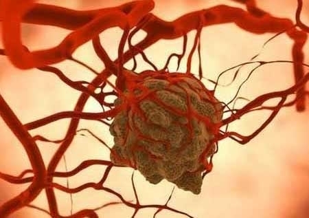 男子福痣剃破发现癌变 宝宝身上的痣如何处理