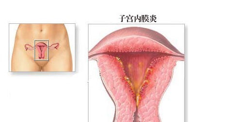科学认识子宫内膜炎症,不做炎症女人