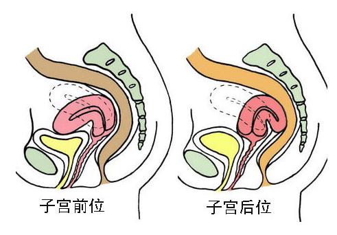 临床多发子宫后位,尽早发现防范于未然