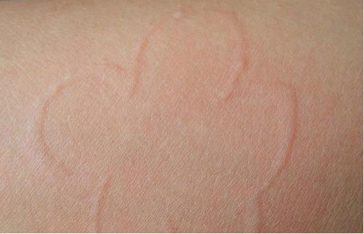 皮肤痒很有可能是荨麻疹!! 荨麻疹会遗传吗?