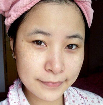 为什么产后容易长斑?吃什么可以淡化色斑？