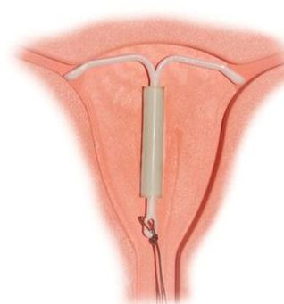 揭秘女性上环全过程(组图)