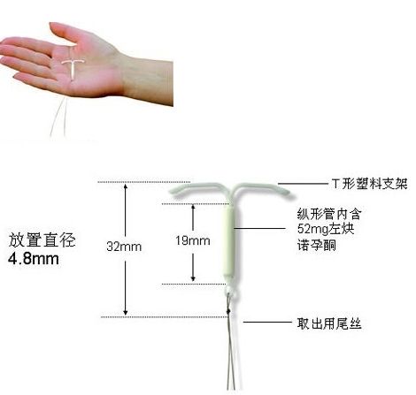 揭秘女性上环全过程(组图)