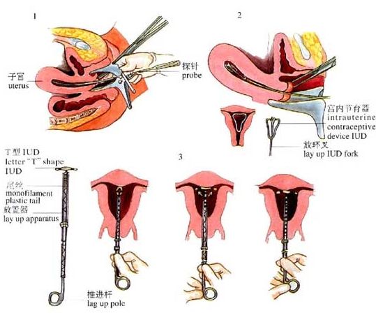 揭秘女性上环全过程(组图)