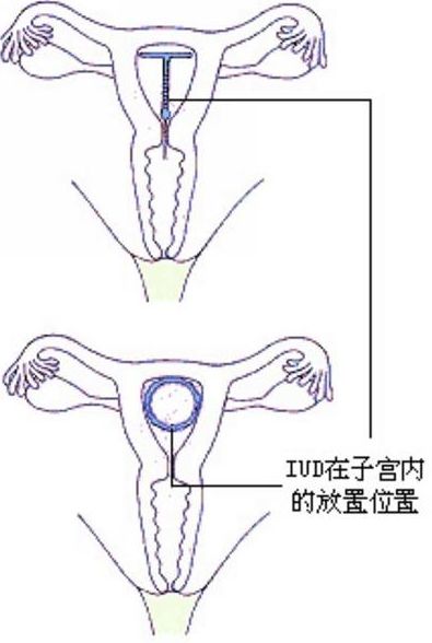 揭秘女性上环全过程(组图)