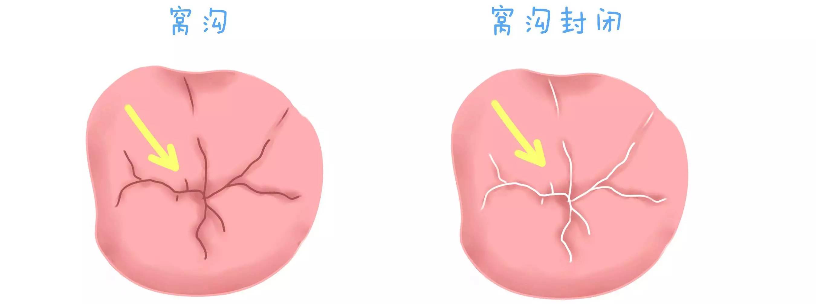 预防宝宝蛀牙有捷径吗？还真有！