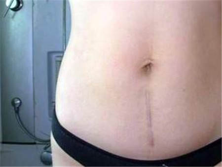 剖腹产横切和竖切的区别 什么是横切什么是竖切 剖腹产横切和竖切的区别 什么是横切什么是竖切