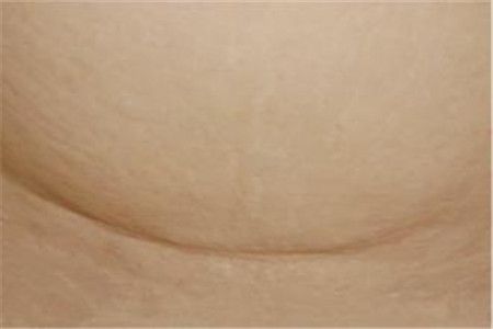 剖腹产横切和竖切的区别 什么是横切什么是竖切 剖腹产横切和竖切的区别 什么是横切什么是竖切