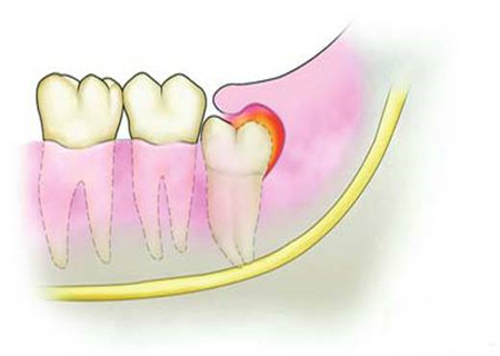 孕妇智齿发炎肿痛难忍怎么办 学会这几招，让你孕期再也不嘴疼