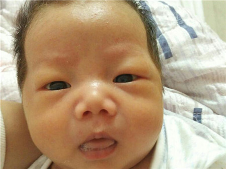 新生儿黄疸值18严重吗，需要照蓝光吗