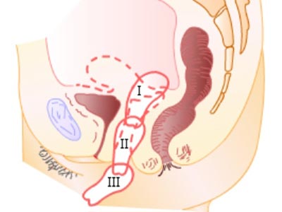 【子宫下垂】子宫下垂的原因_子宫下垂的危害_子宫下垂的预防