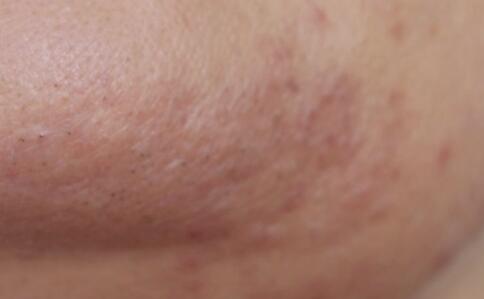 不同部位女性湿疹症状图片