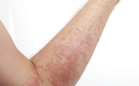 不同部位女性湿疹症状图片