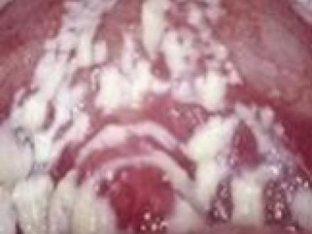 白带像豆腐渣怎么回事用什么药