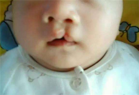 怎么预防胎儿兔唇 备孕期间就要开始注意