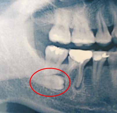 智齿一定要拔吗：这种情况智齿一定要拔掉（附拔智齿图）