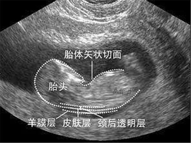 孕妈妈如何通过四维彩超对比图辨别胎儿性别