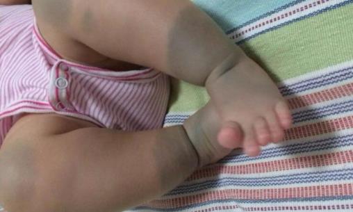 身上带有胎记的人是怎么回事：关于胎记的传说详解