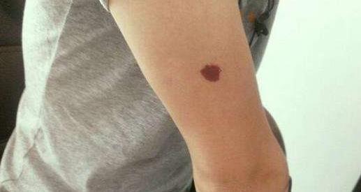 身上带有胎记的人是怎么回事:关于胎记的传说详解