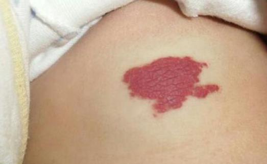 身上带有胎记的人是怎么回事：关于胎记的传说详解